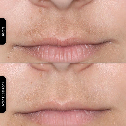 LEDMask | Amélioration de la peau avec la technologie LED